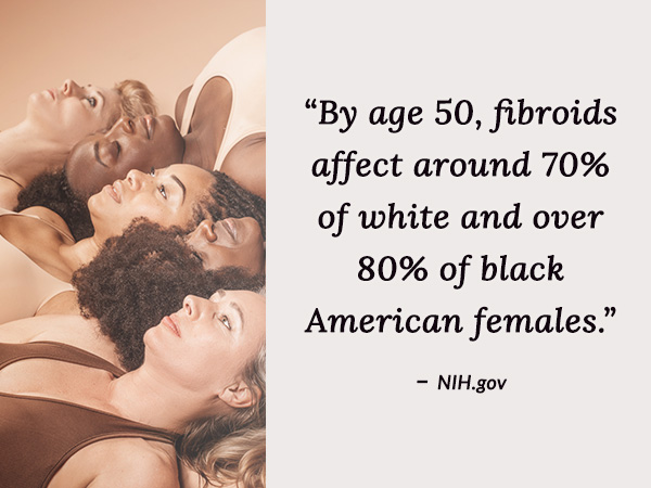 By age 50, fibroids affect around 70% of white and over 80% of Black American females. 